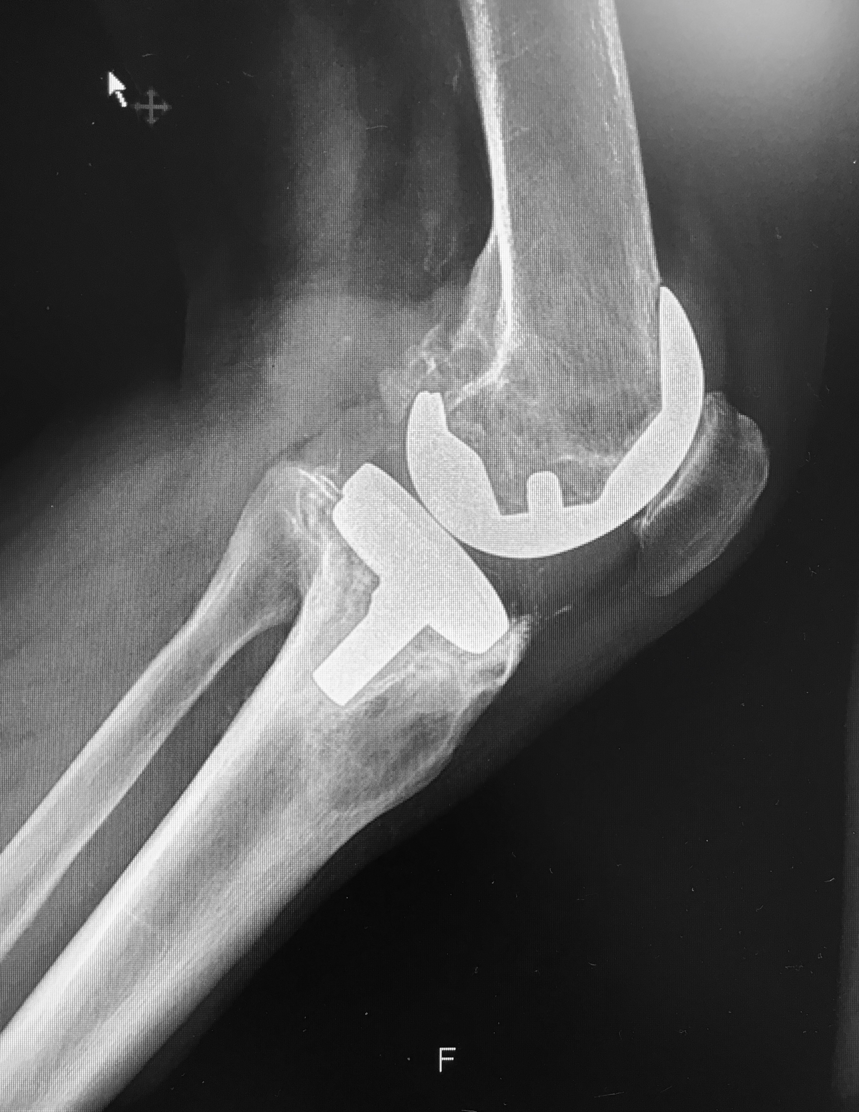 protesi totale ginocchio