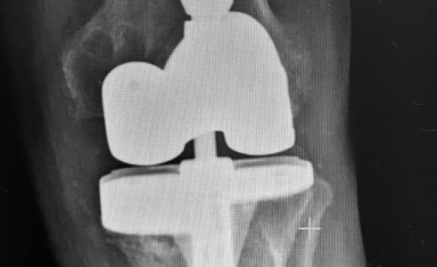 protesi totale ginocchio