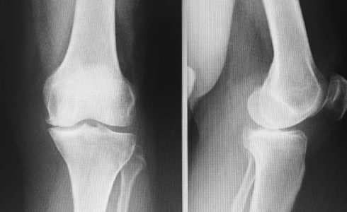 protesi monocompartimentale ginocchio interna