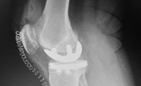 protesi monocompartimentale ginocchio interna