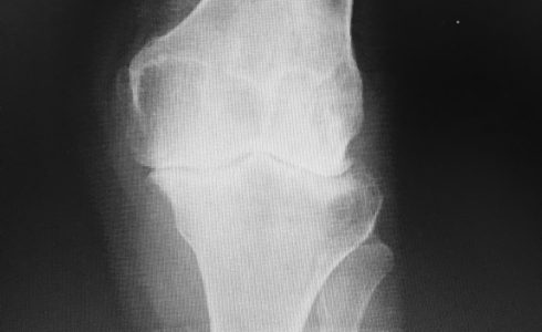 protesi totale al ginocchio