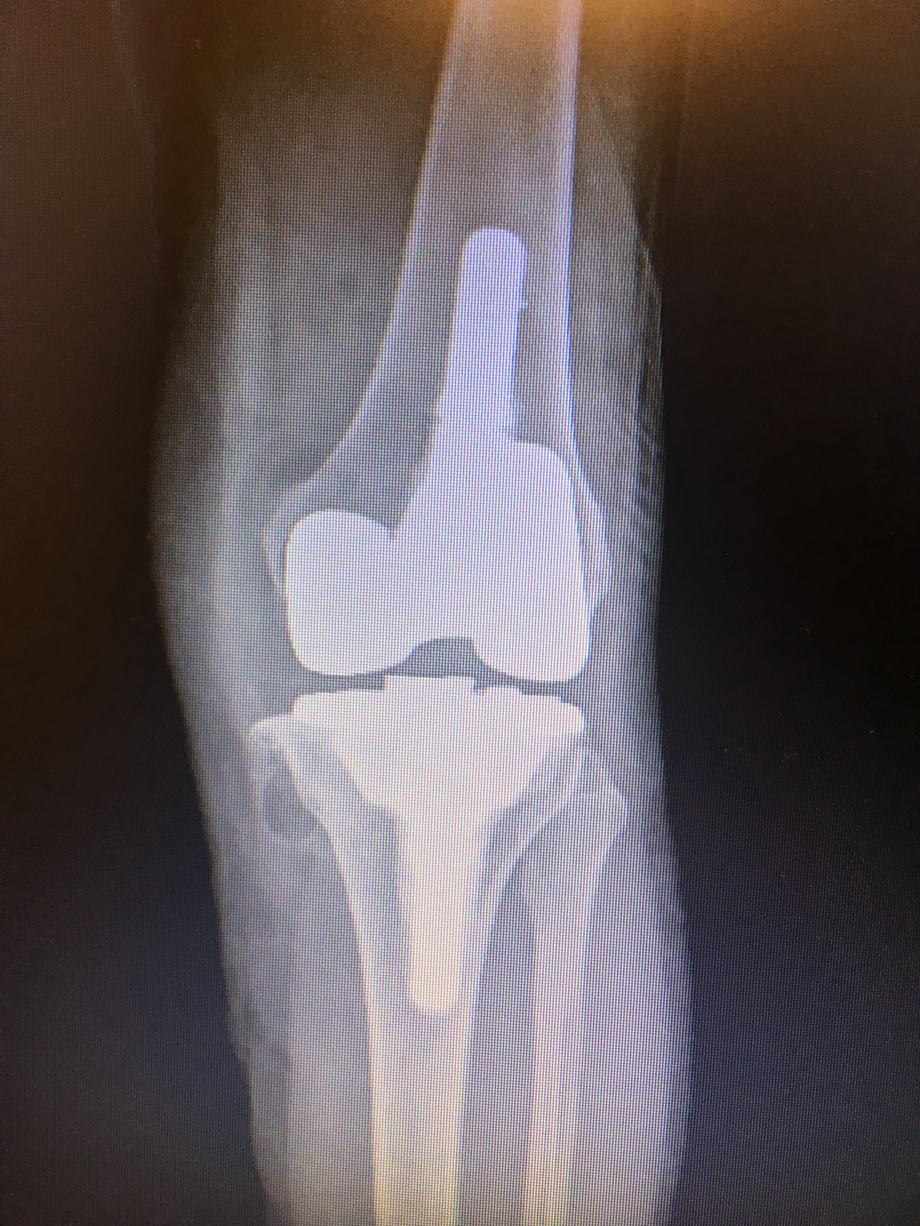 protesi totale al ginocchio