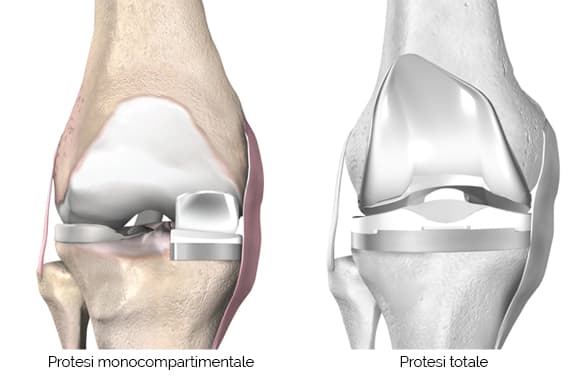 protesi monocompartimentale del ginocchio ortopedico specializzato