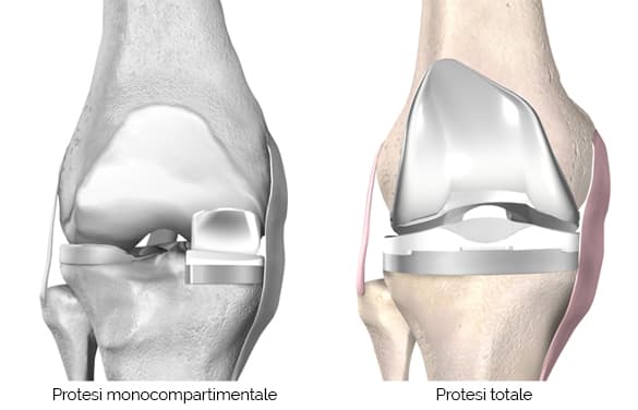 protesi totale del ginocchio ortopedico specializzato